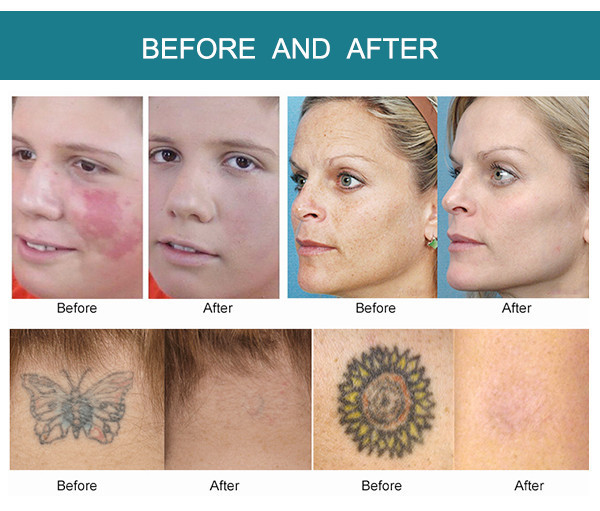 SW-C755 picolaser freckle removal face dumb improve facial blemish 1800W power age spots remoavl laser picosecond